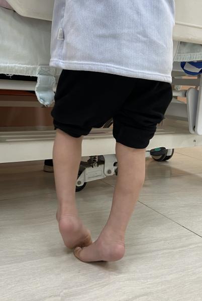 肌张力高就是脑瘫吗?