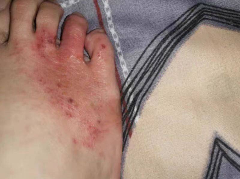 脚心长水疱很痒是什么原因