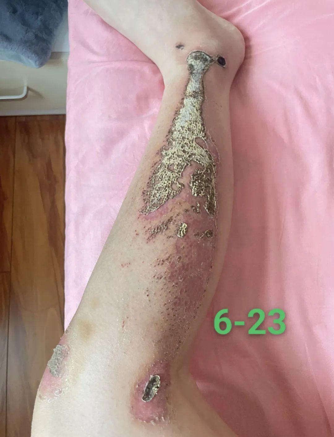 伤口愈合的过程是什么