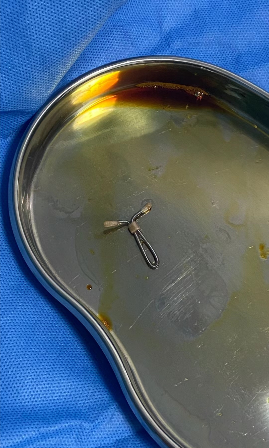 取环手术是什么