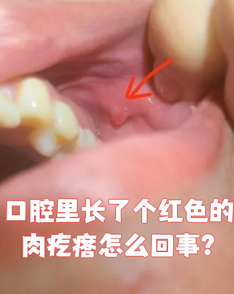 口腔囊肿是什么引起的