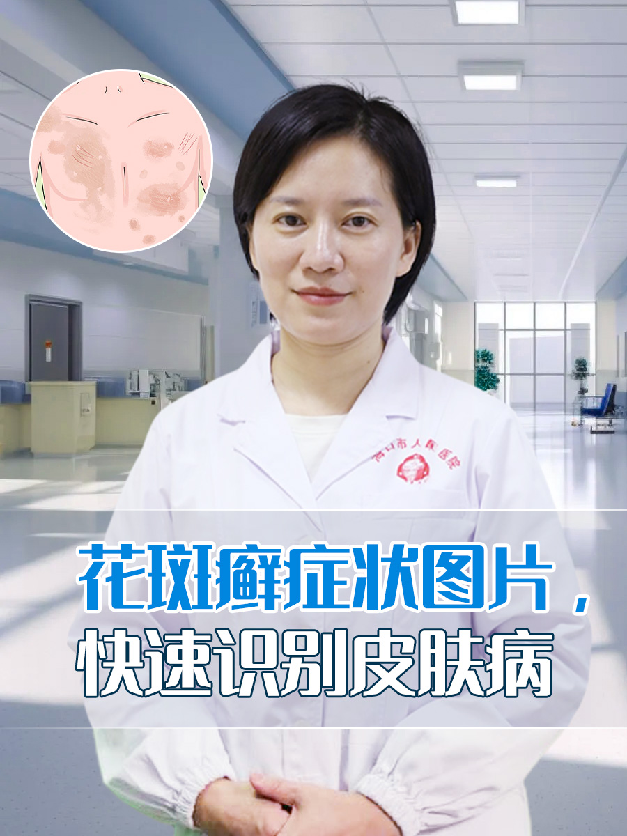 花斑癣会传染给别人吗