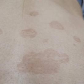 花斑癣会传染给别人吗