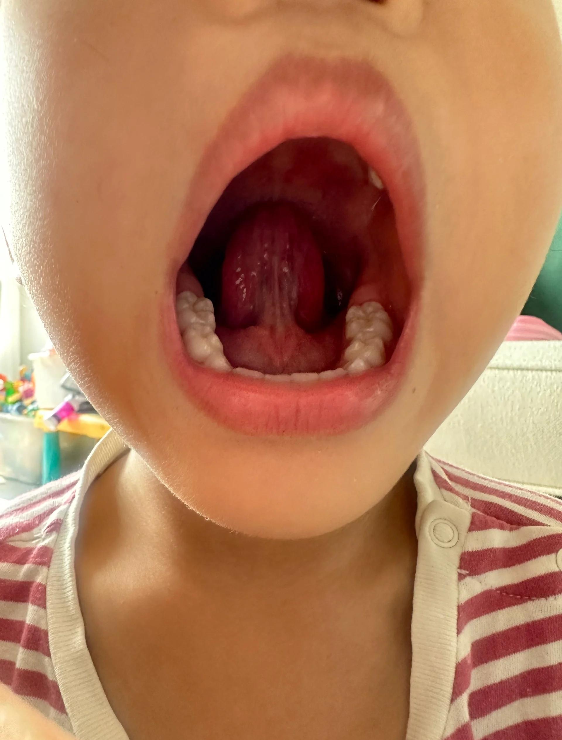 舌系带短怎么办