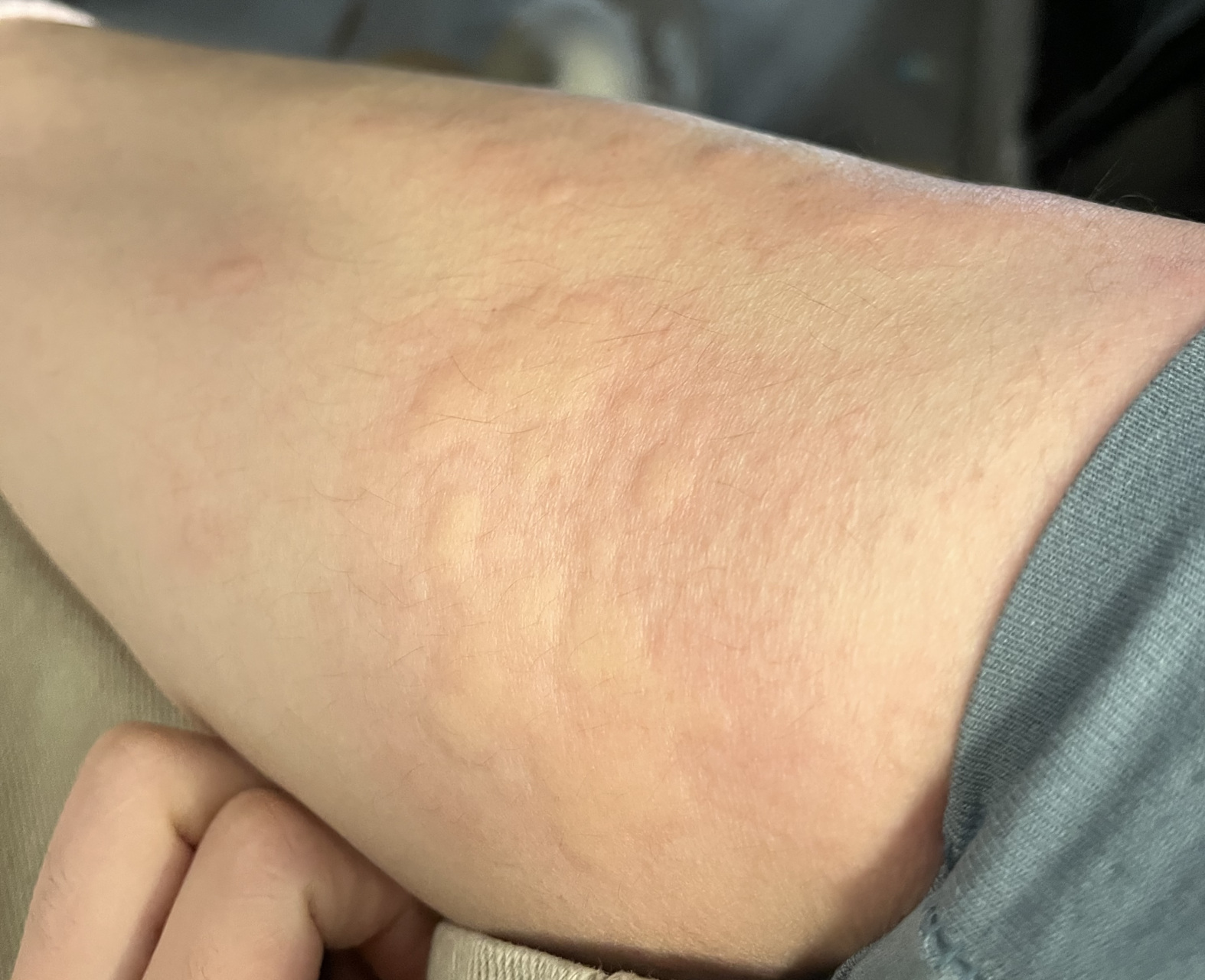 身上起像蚊子咬了的疙瘩,很痒,是怎么回事