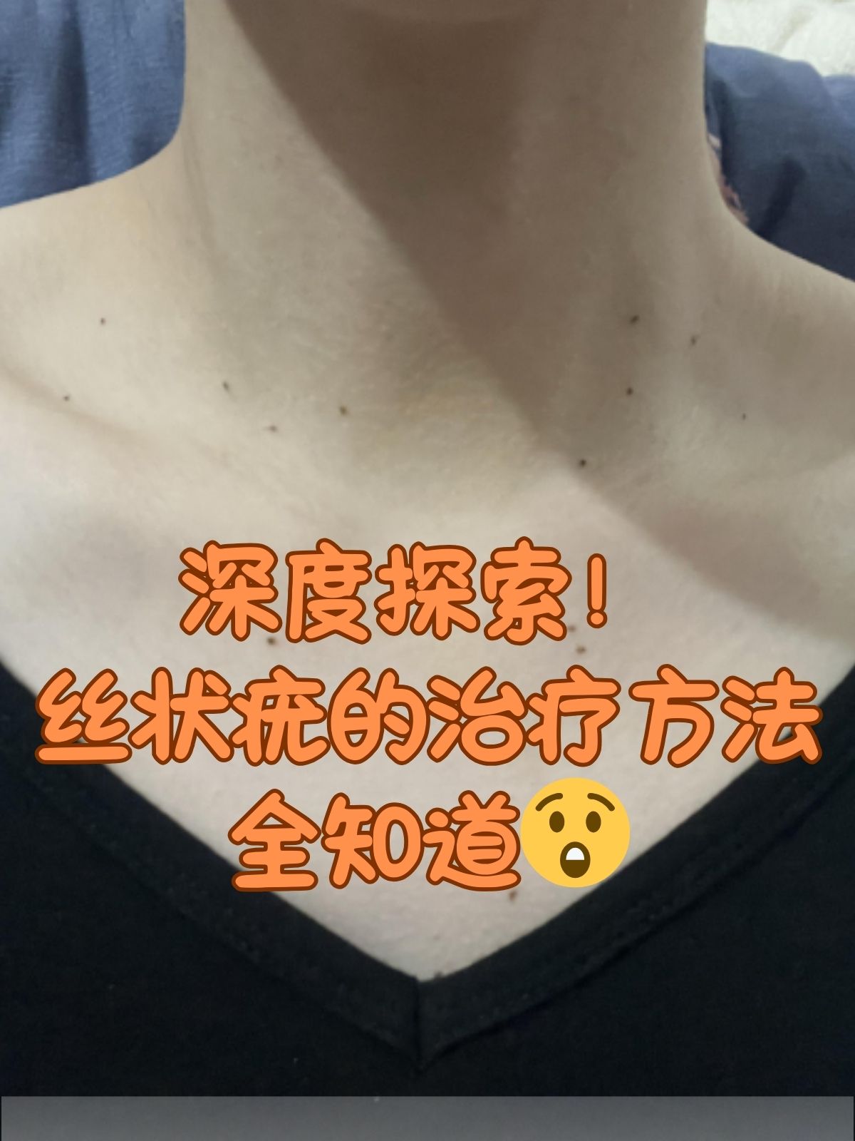 什么是丝状疣?