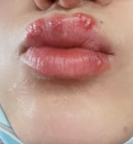 嘴角起泡有图片是上火吗