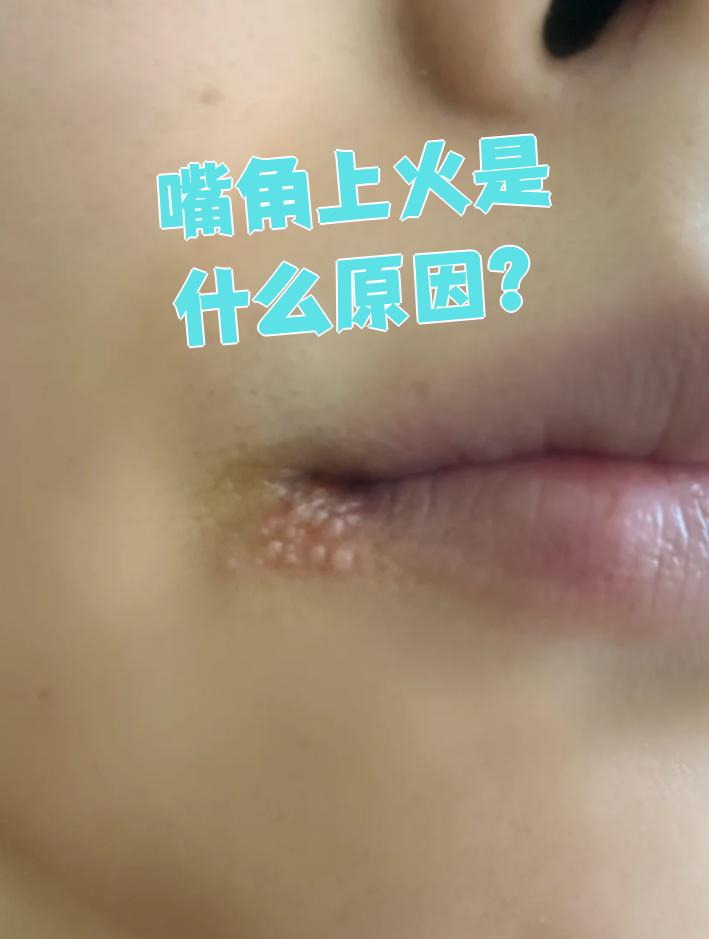 嘴角起泡有图片是上火吗