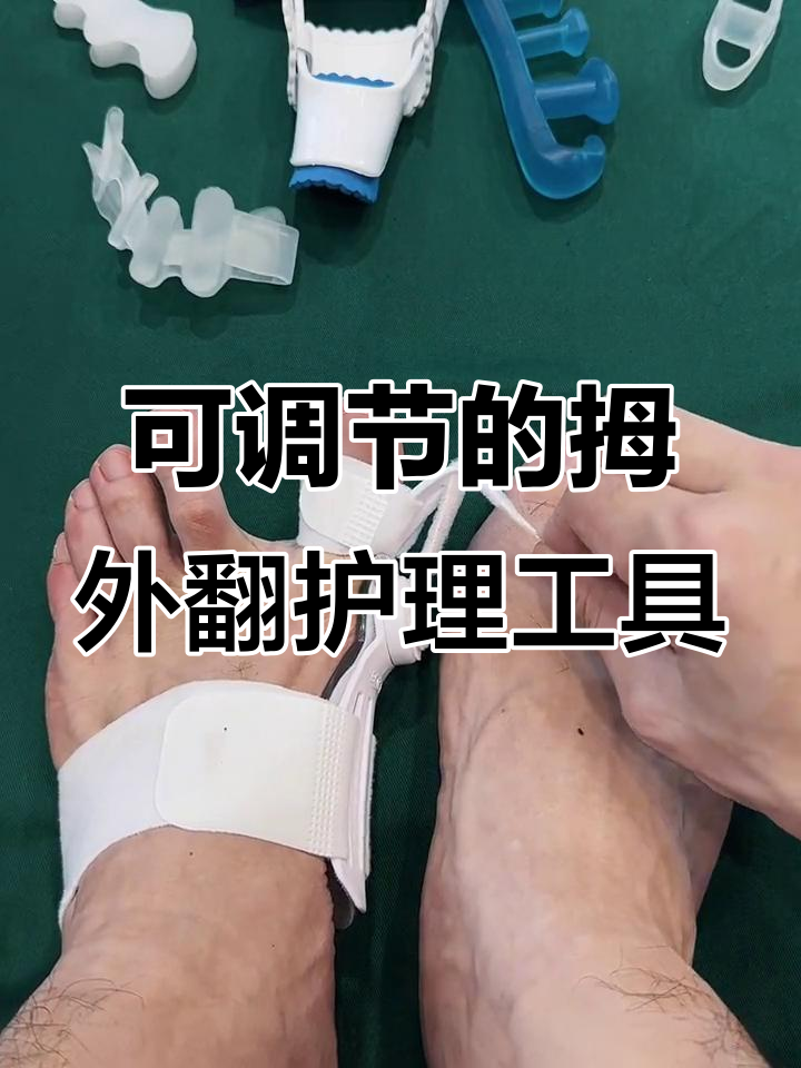 拇外翻矫正器管用吗