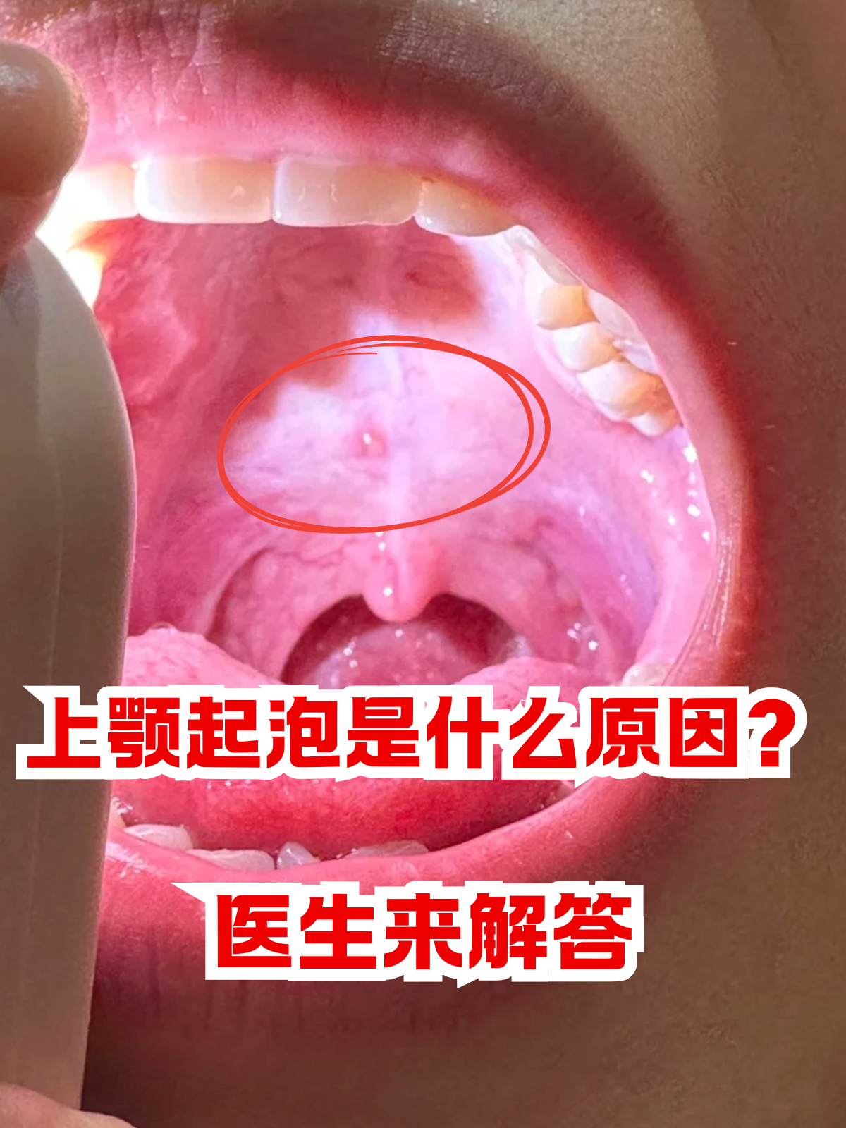 上颚长了一个疙瘩很硬,不疼