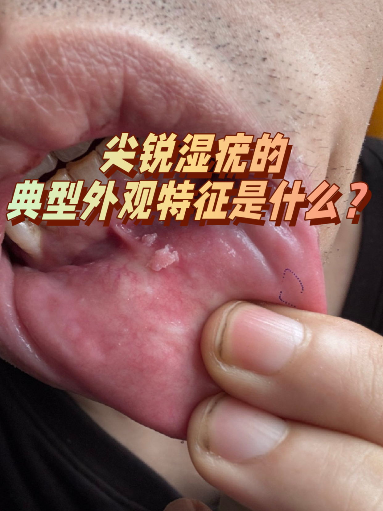 尖锐湿疣如果不治疗会怎么样?