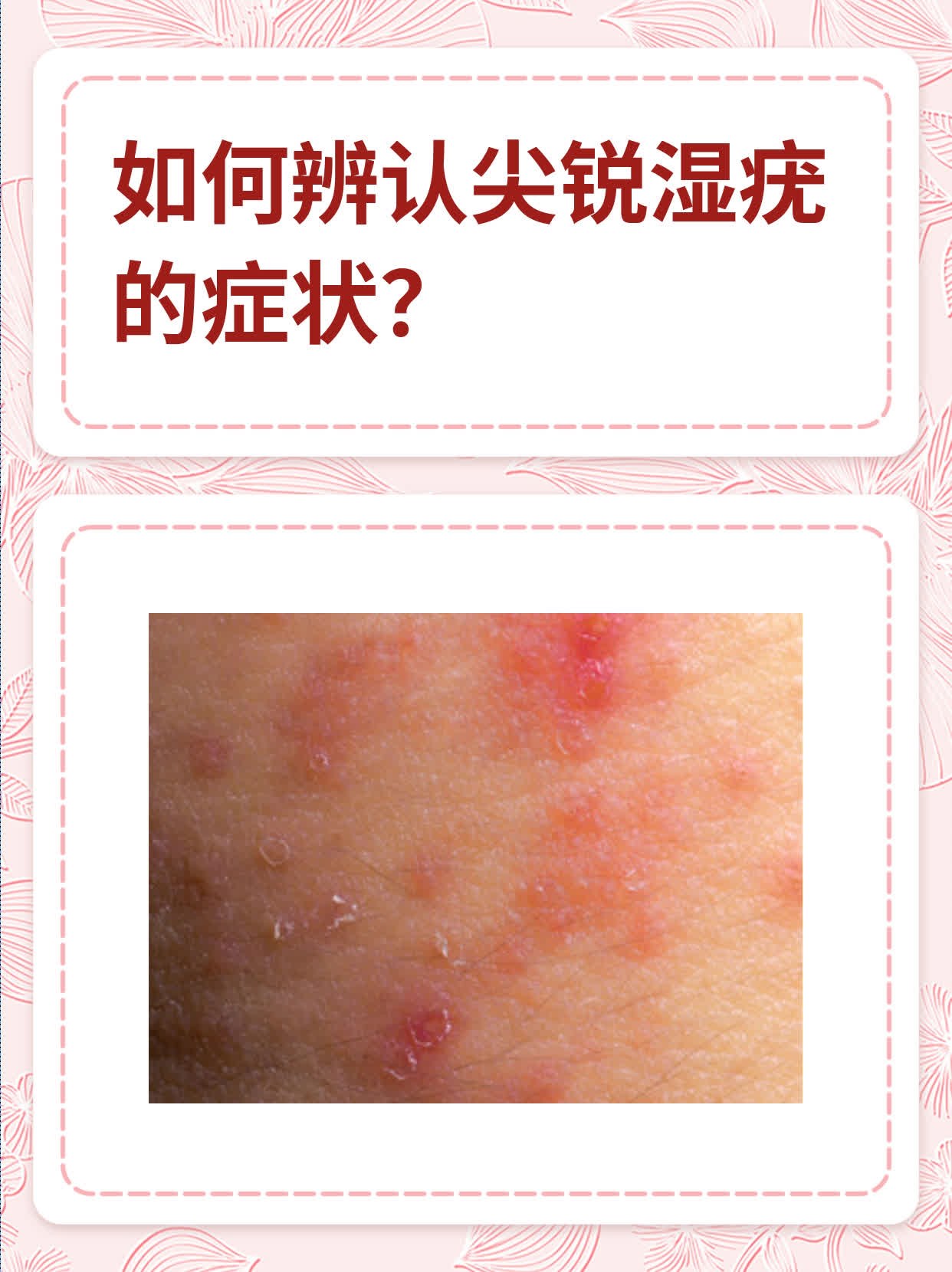 尖锐湿疣复发的症状有哪些