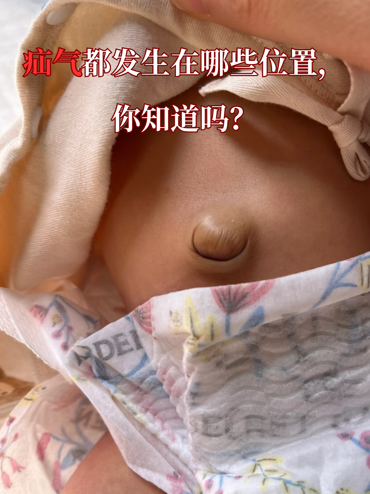 女性疝气会有什么症状?
