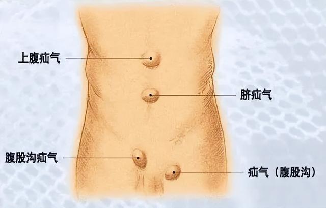 女性疝气会有什么症状?