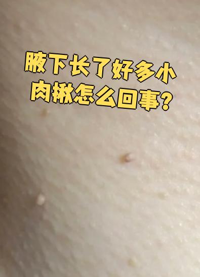 腋下长了个肉疙瘩怎么回事