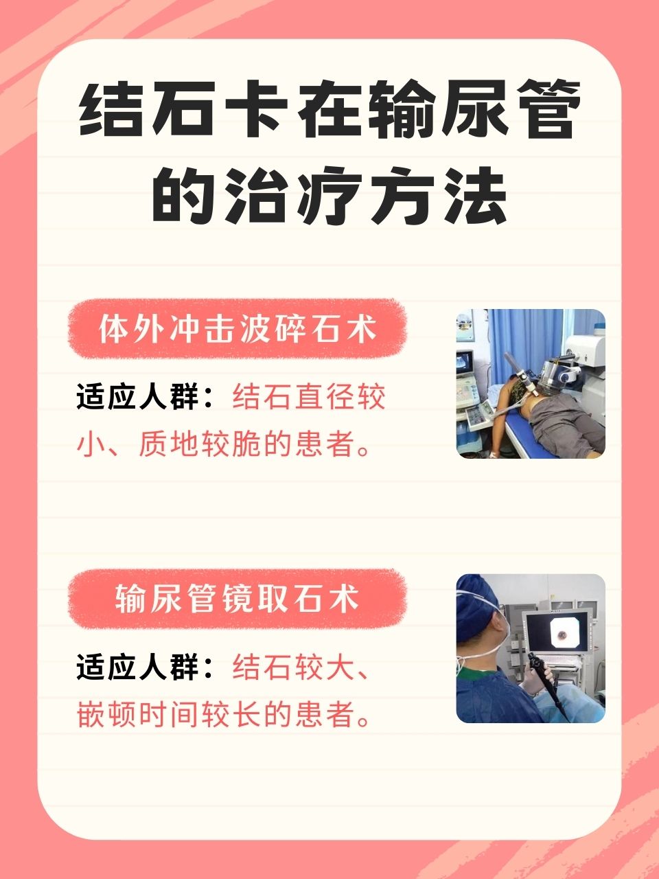 输尿管下段结石怎么治疗
