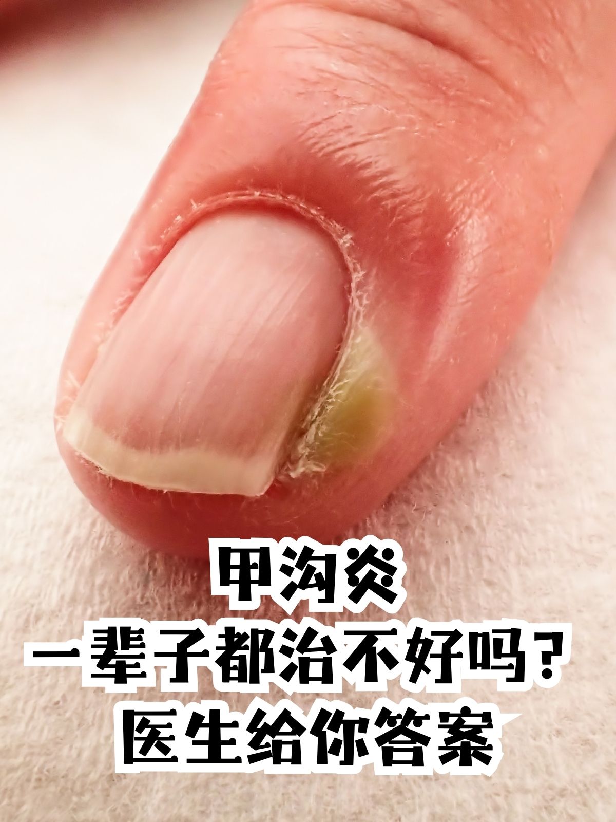 手指甲沟炎怎么治疗