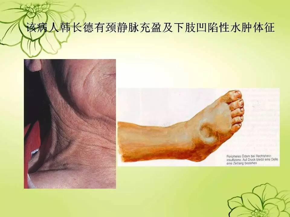 颈静脉充盈是怎么回事?