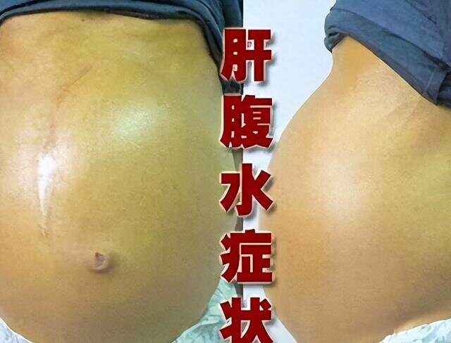 肝腹水能完全治愈吗?