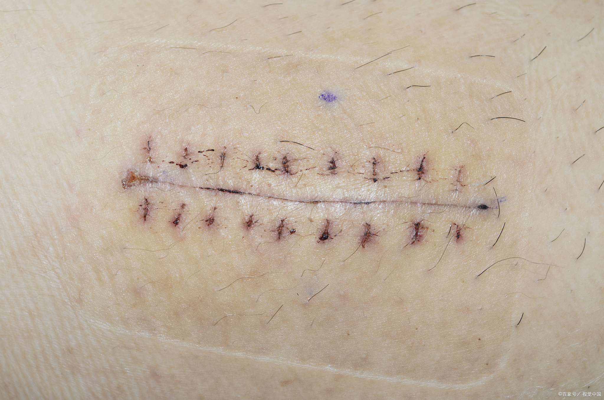 一般小伤口缝合后几天拆线