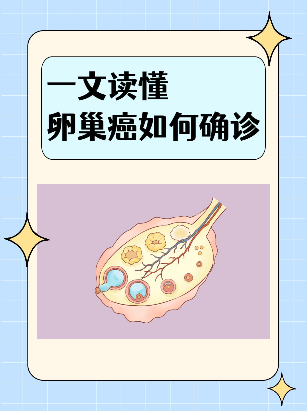 得了卵巢癌能彻底治愈吗?