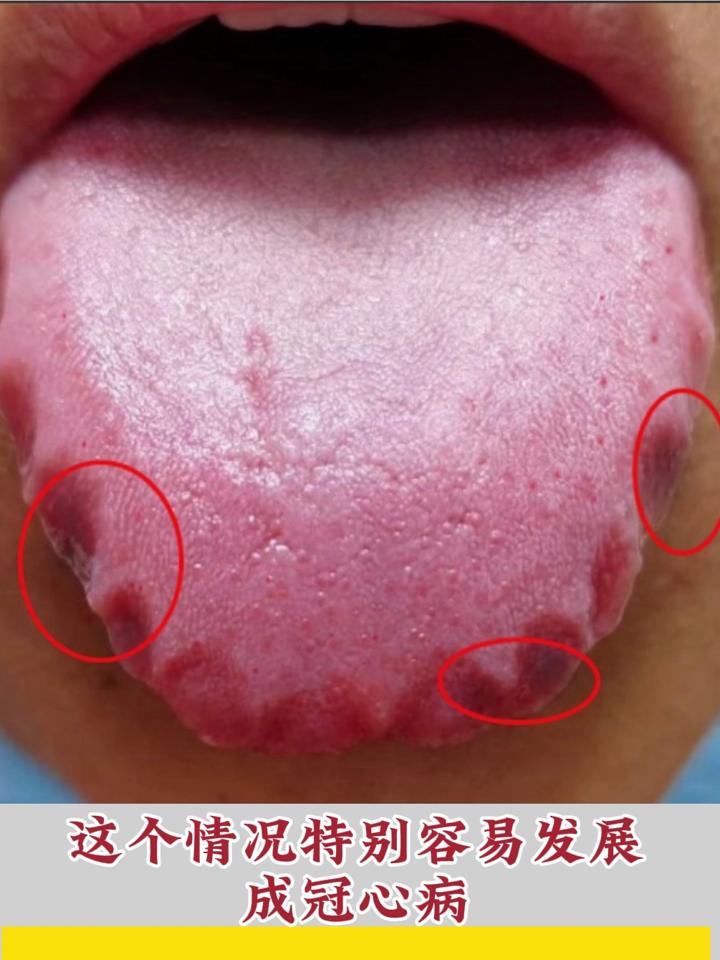 舌头上有齿痕是怎么回事