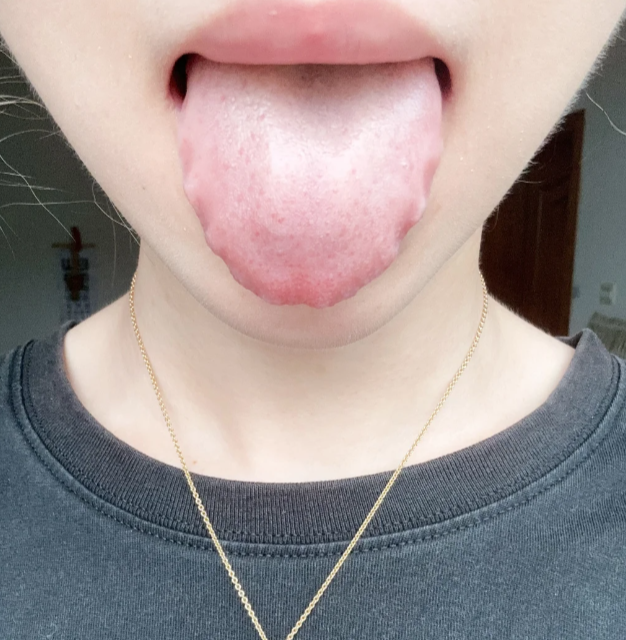 舌头上有齿痕是怎么回事