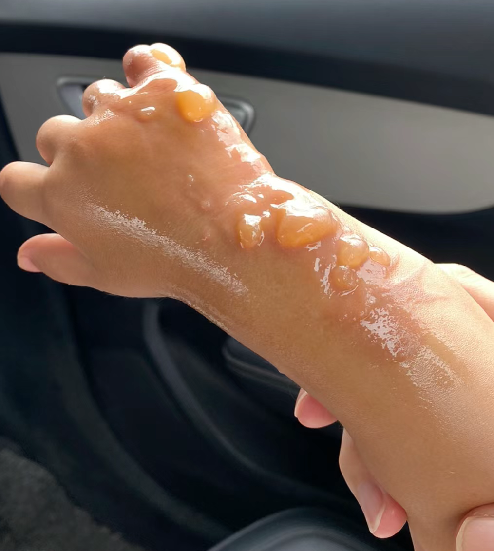 被开水烫出了水泡怎么办