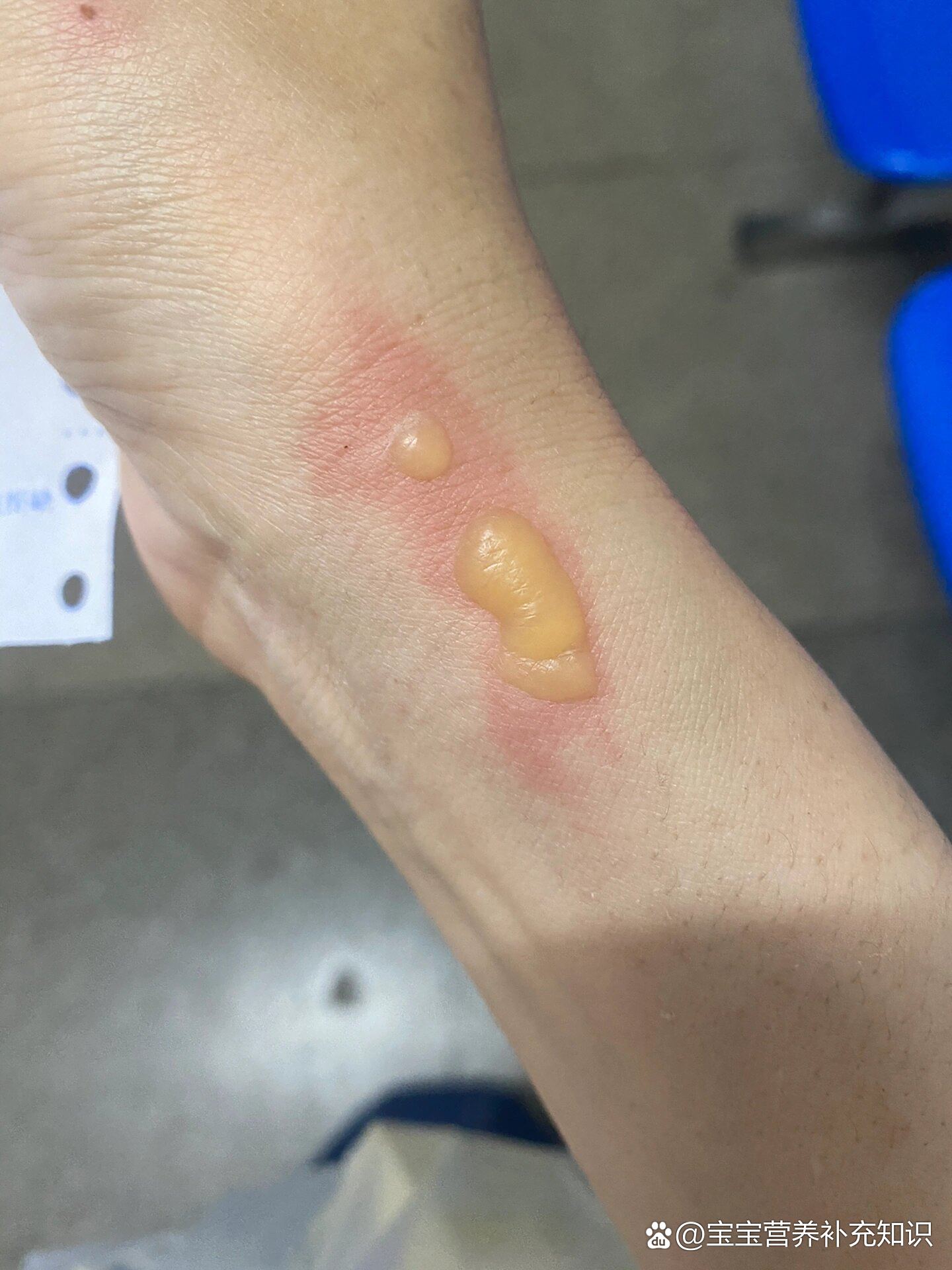 被开水烫出了水泡怎么办