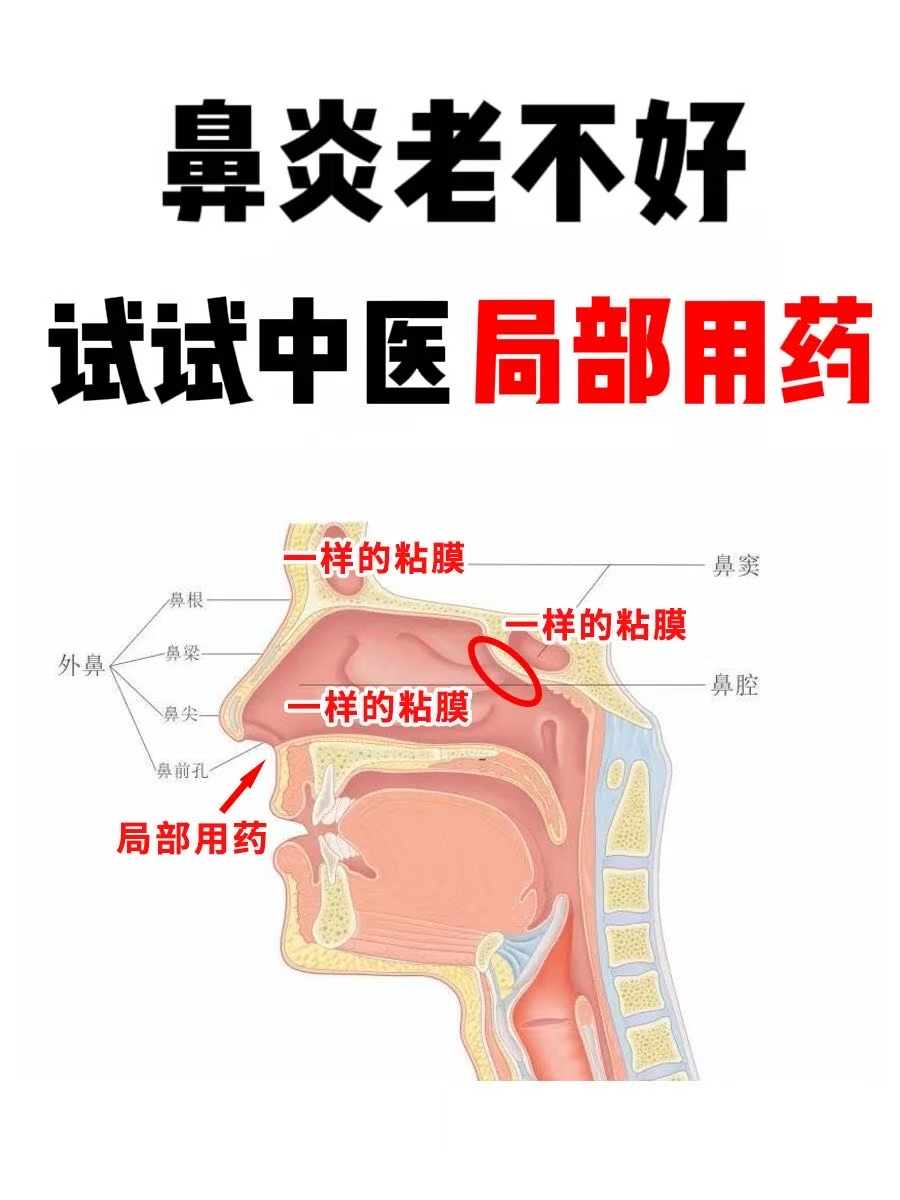 鼻窦炎最好的治疗方法是什么
