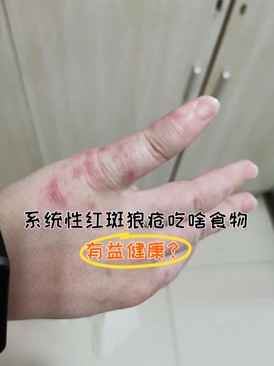 红斑狼疮究竟能活多久