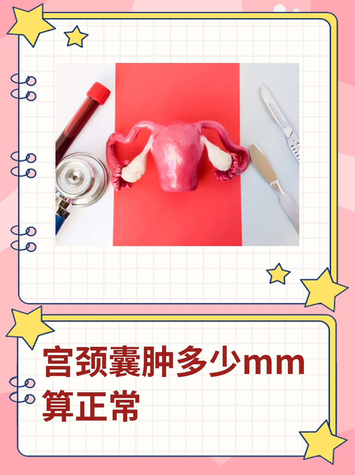 什么是宫颈纳氏囊肿?