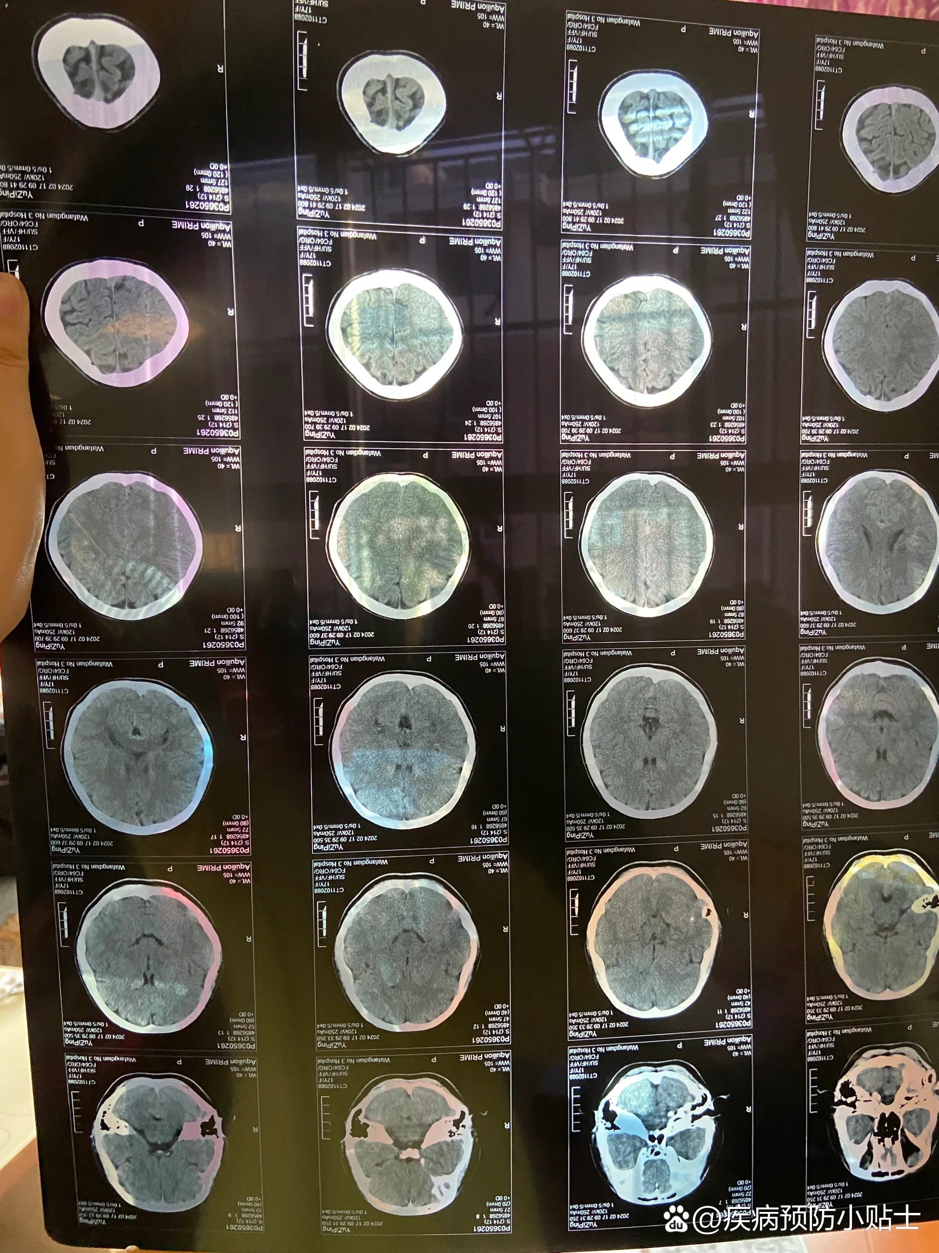 脑部核磁共振检查什么情况