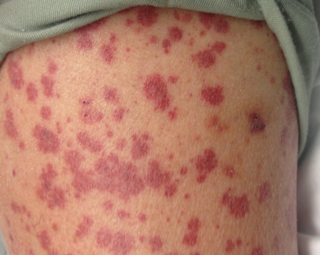 血管炎的症状有哪些