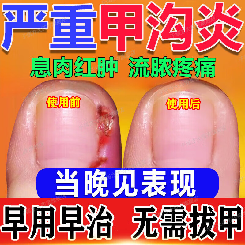 甲沟炎用什么药膏好得快