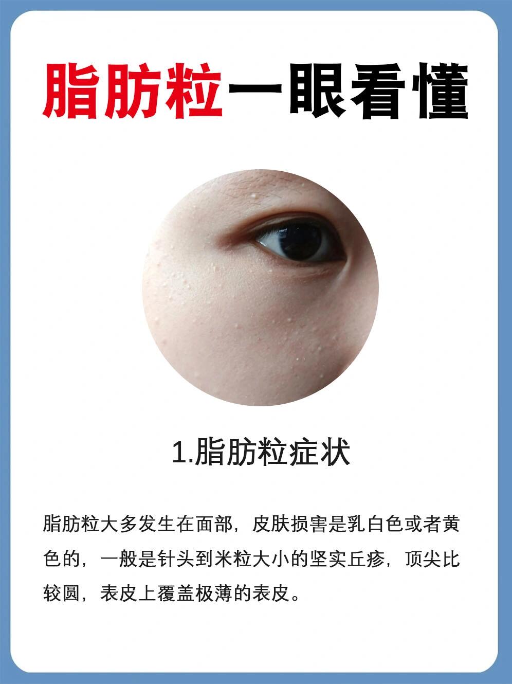 眼角长了脂肪粒怎么办