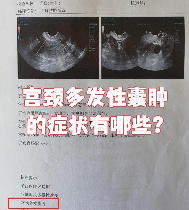 得了子宫囊肿有哪些危害