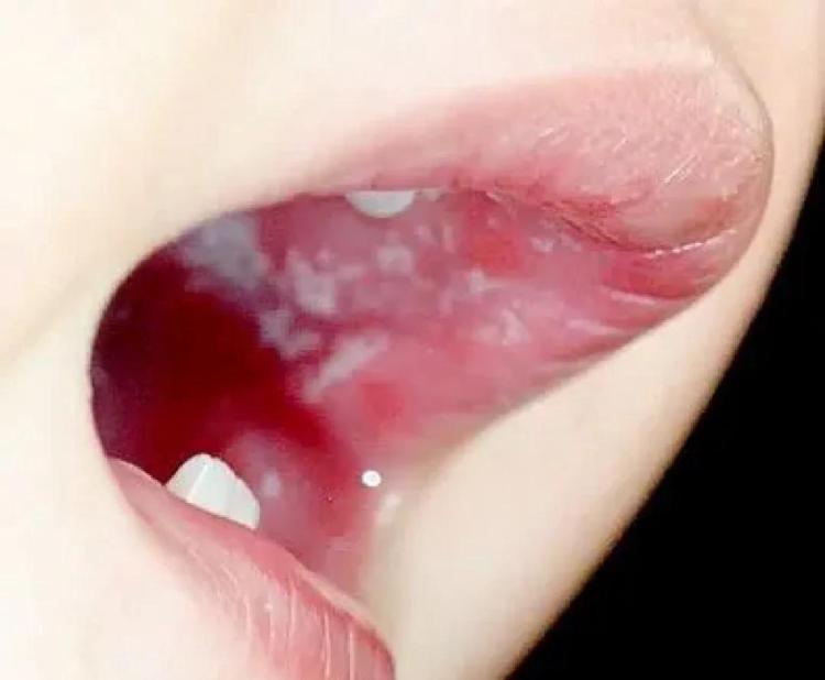 马牙子和鹅口疮的区别