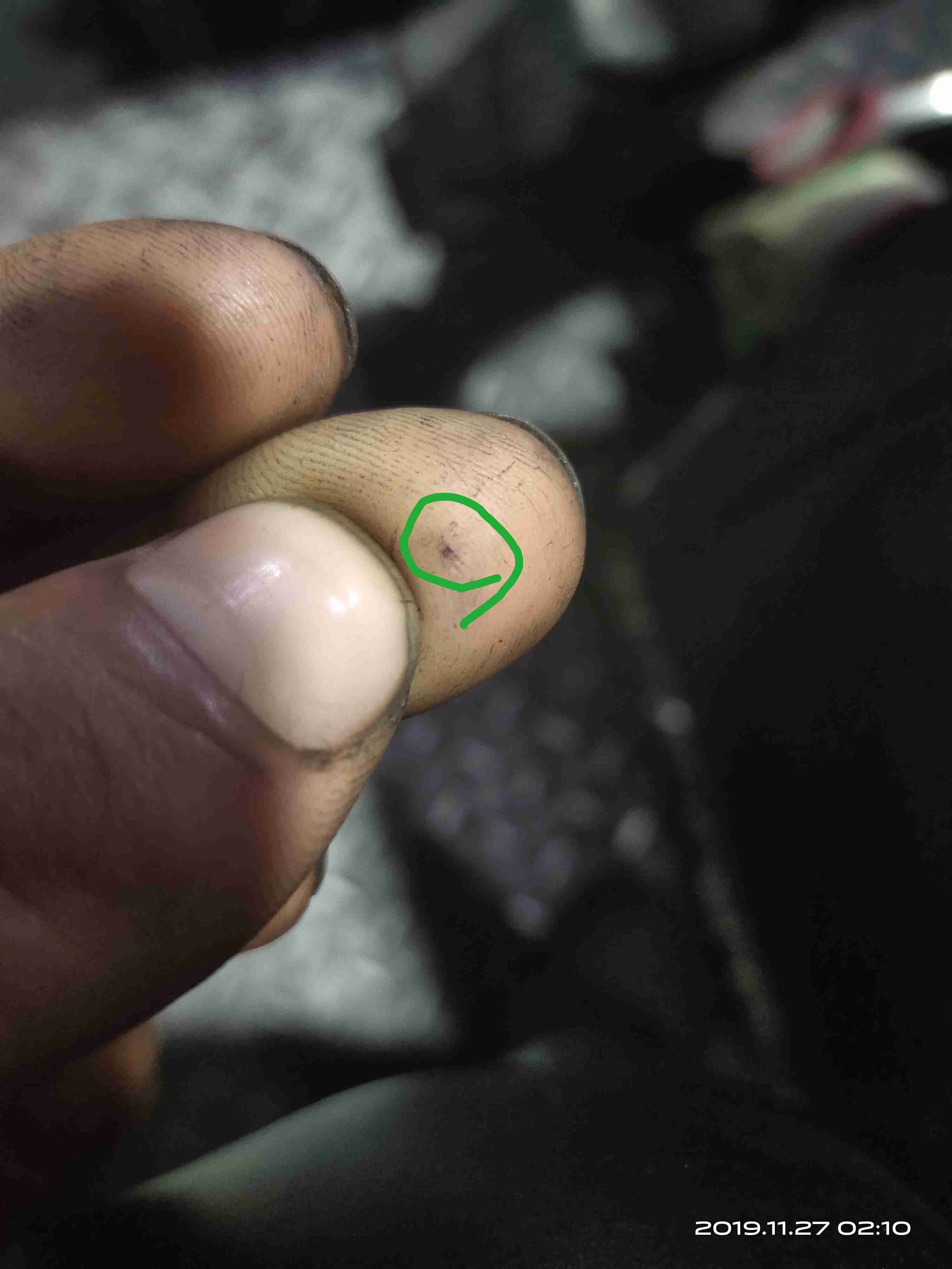 腿上长了黑色的斑点是怎么回事