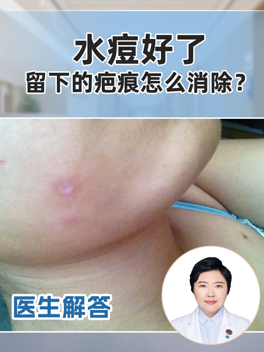 水痘下去后,有结痂,但我扣了