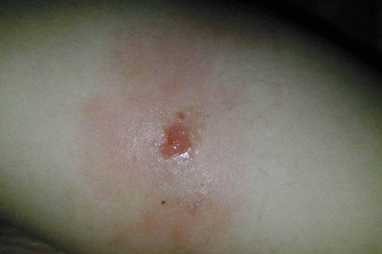 水痘下去后,有结痂,但我扣了