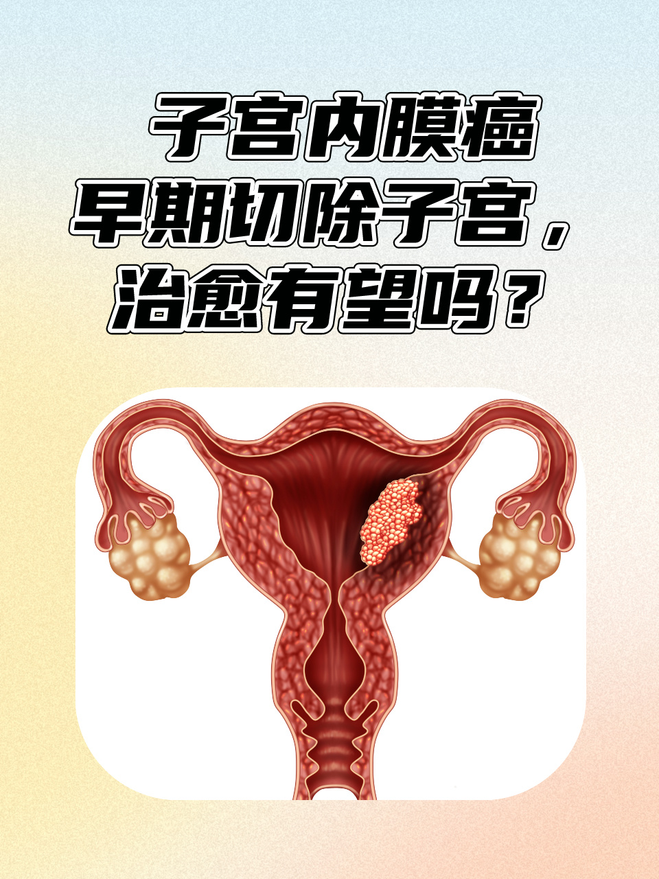 子宫内膜癌怎么检查出来