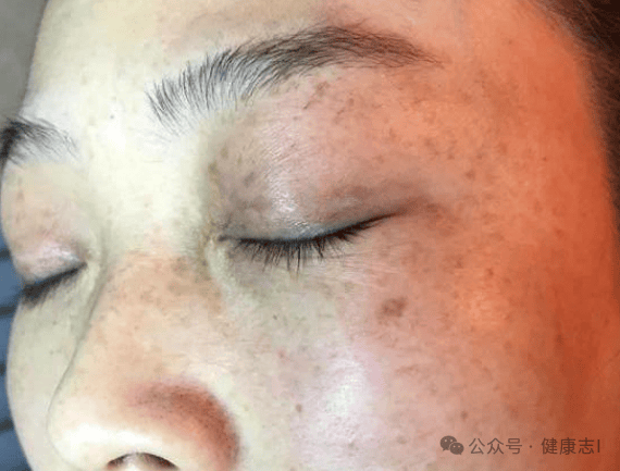 女性血脂高有哪些症状