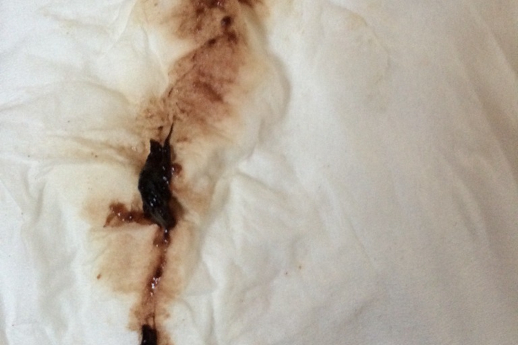 宫外孕会来例假吗