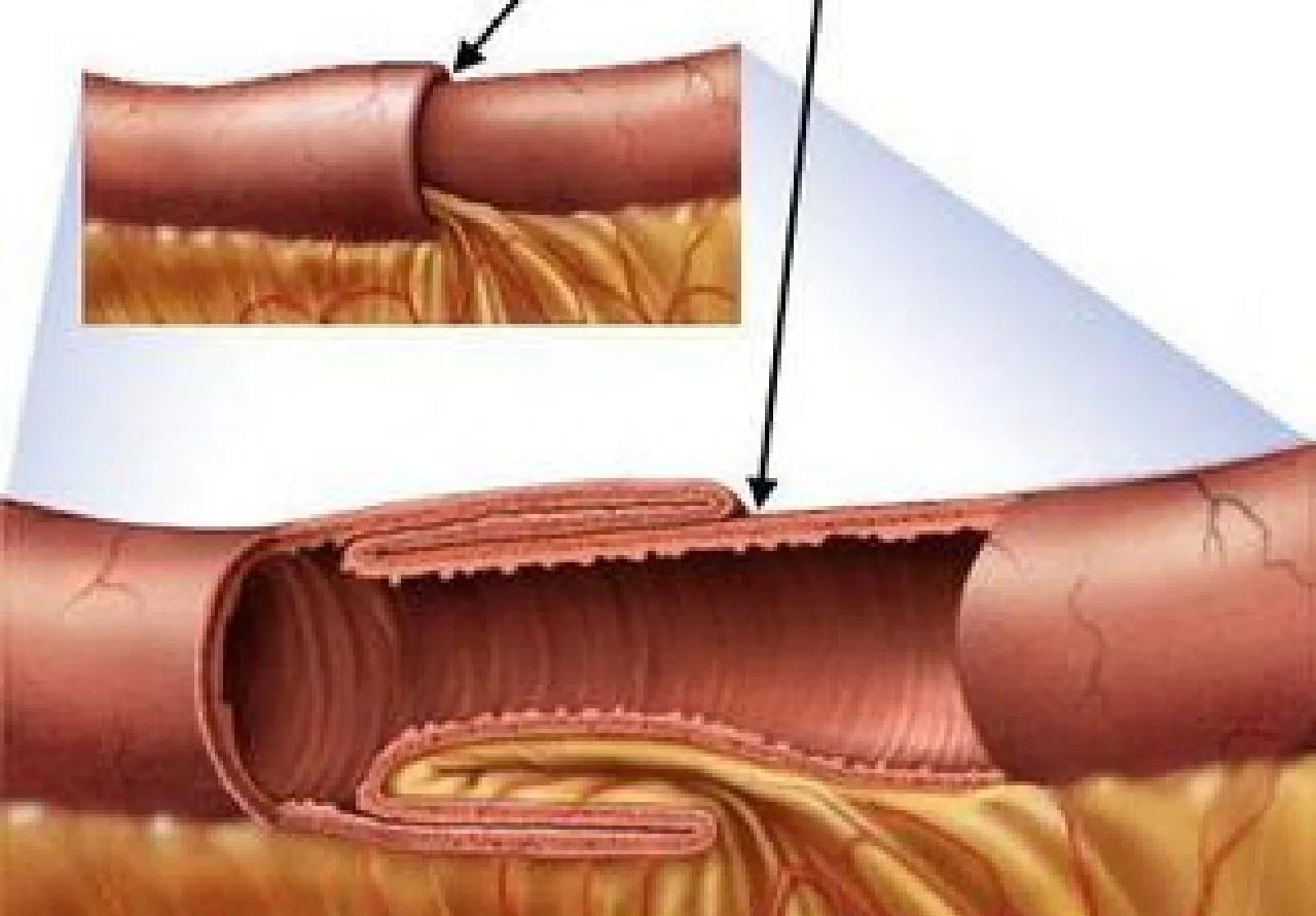 婴儿肠套叠是怎么回事