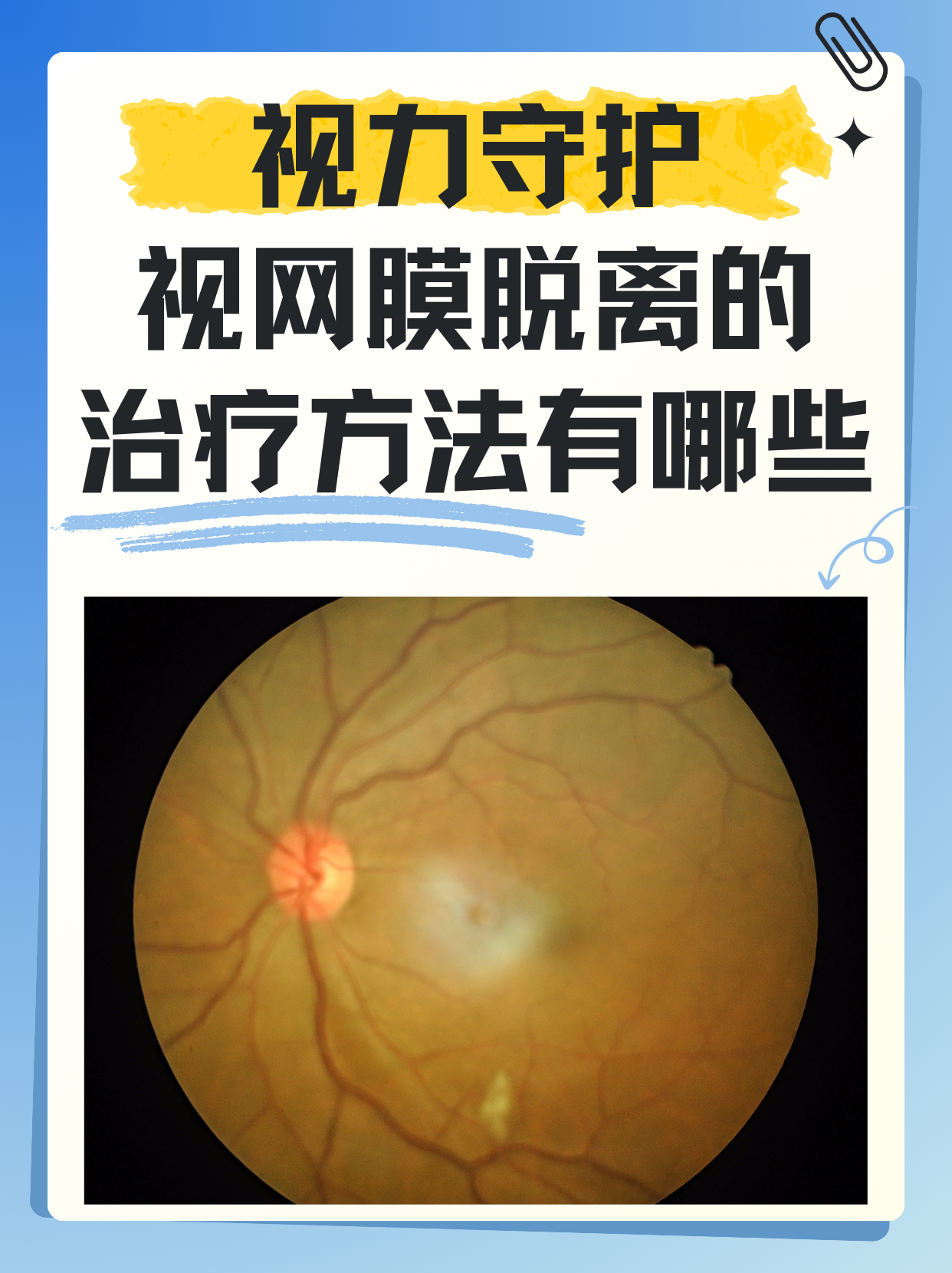 视网膜脱落是怎么引起的