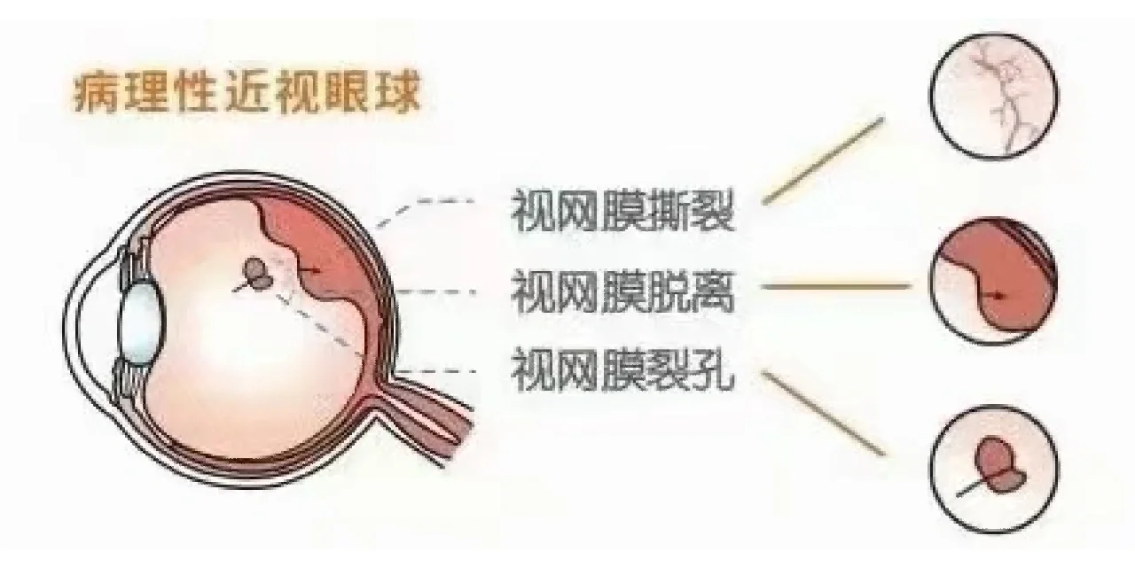 视网膜脱落是怎么引起的
