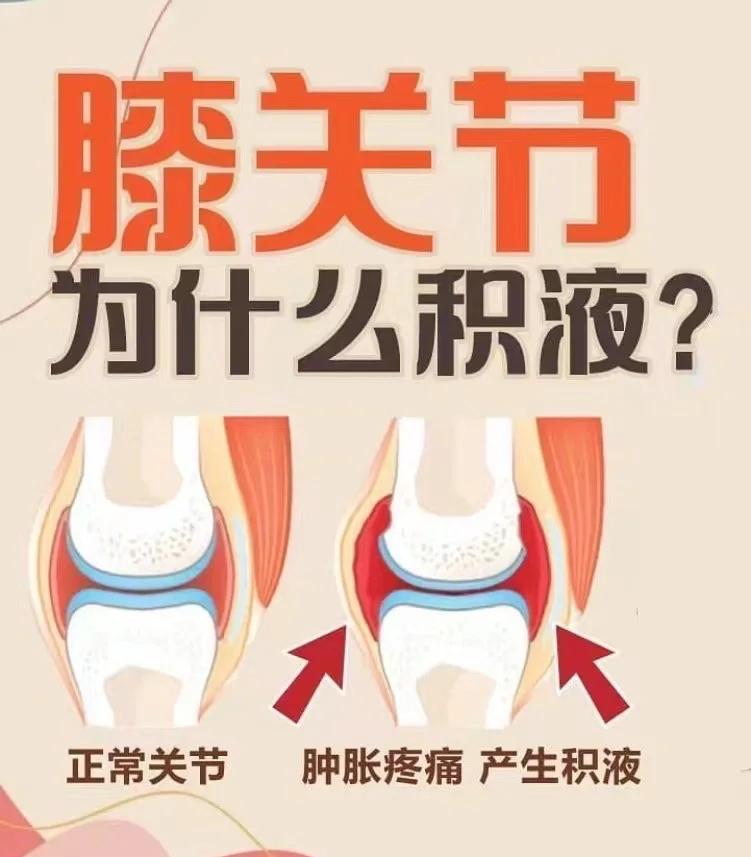 膝关节有积水是什么原因