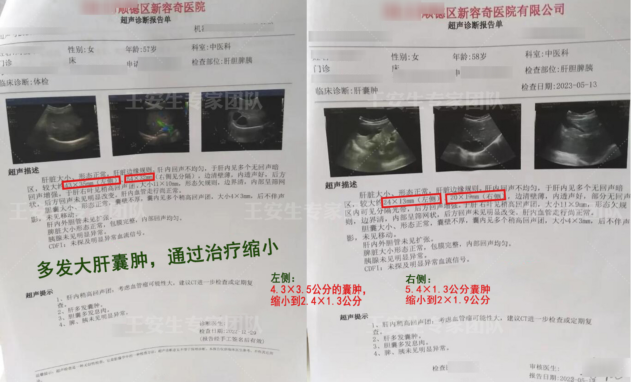 多发性肝囊肿能活多久