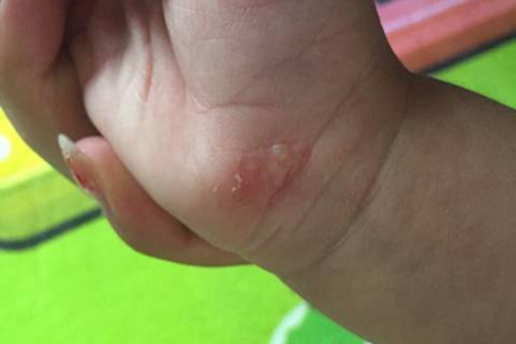 尿毒症的症状有